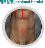 절개탈장(Incisional Hernia)