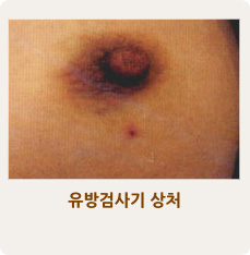 유방검사기 상처